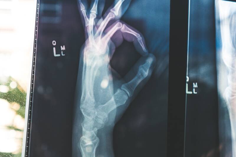 X-ray hand doing OK sign