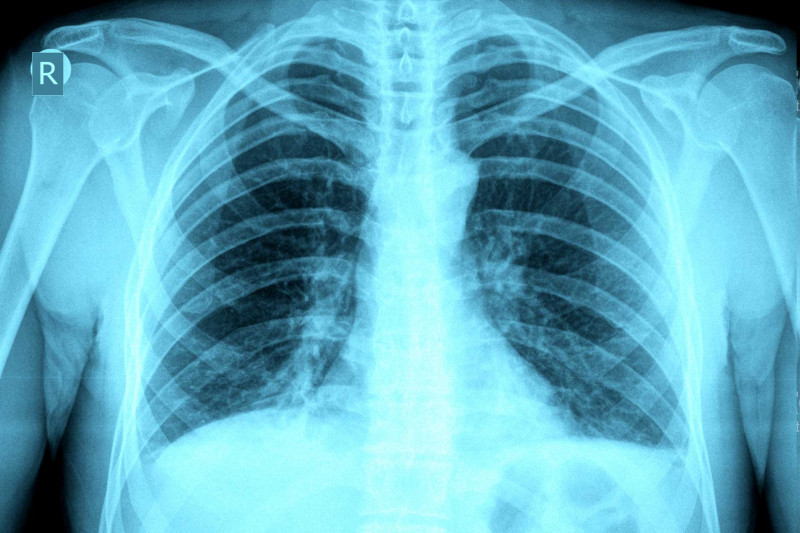 X-ray showing a human chest